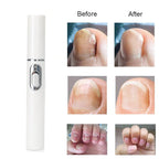 Blue Light Anti-Fungal Laser Pen - Effective, Non-Invasive, and Portable